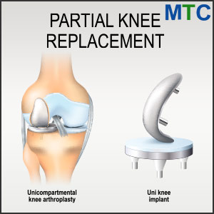 Partial knee replacement in Barcelona, Spain