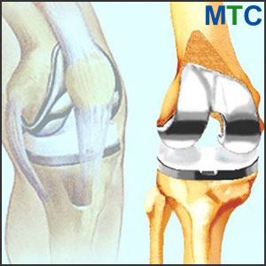 Total knee replacement in Barcelona, Spain