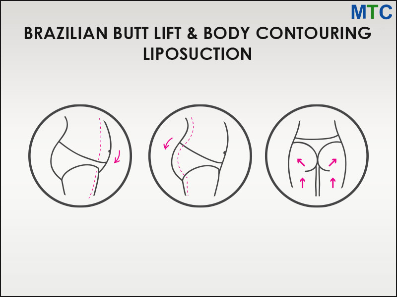 BBL & Body contouring Liposuction
