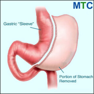 Gastric sleeve in India