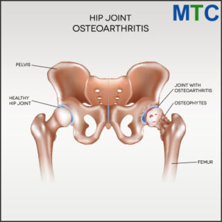osteoarthritis 
