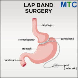 Lap Band Surgery in Las Vegas