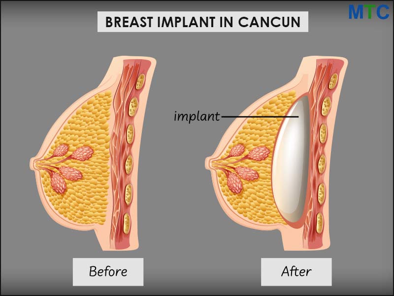 Breast implant in Cancun