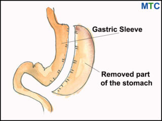 Gastric sleeve in Cancun, Mexico