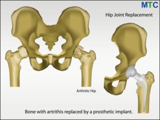 Hip-replacement-illustration-3
