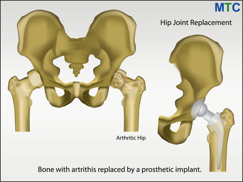 Hip replacement illustration