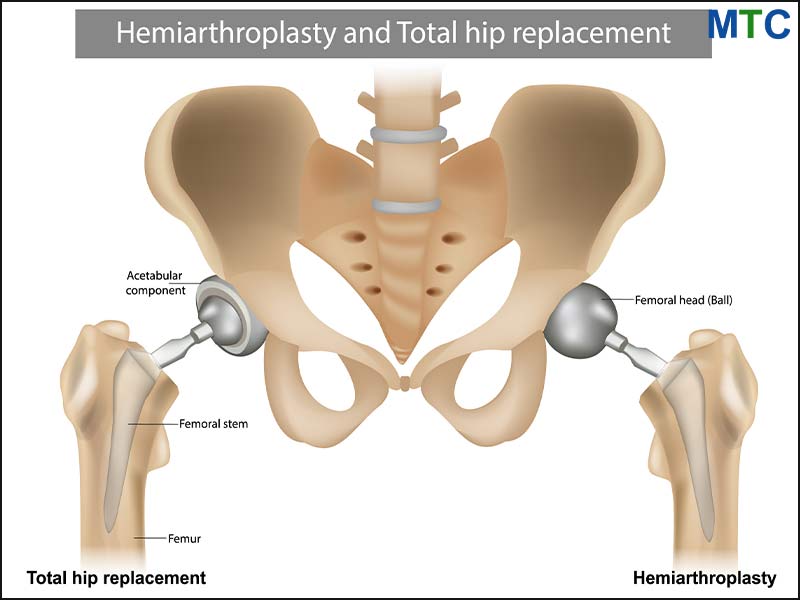 Hip-replacement in Lithuania