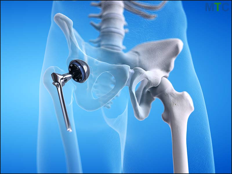 hip replacement in puerto vallarta