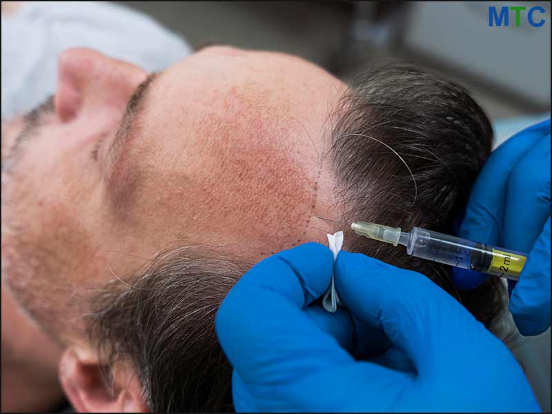 Stem Cell Therapy for Hair Loss