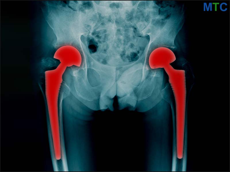 Total Hip replacement xray