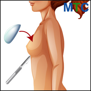 Breast implant in Cancun, Mexico