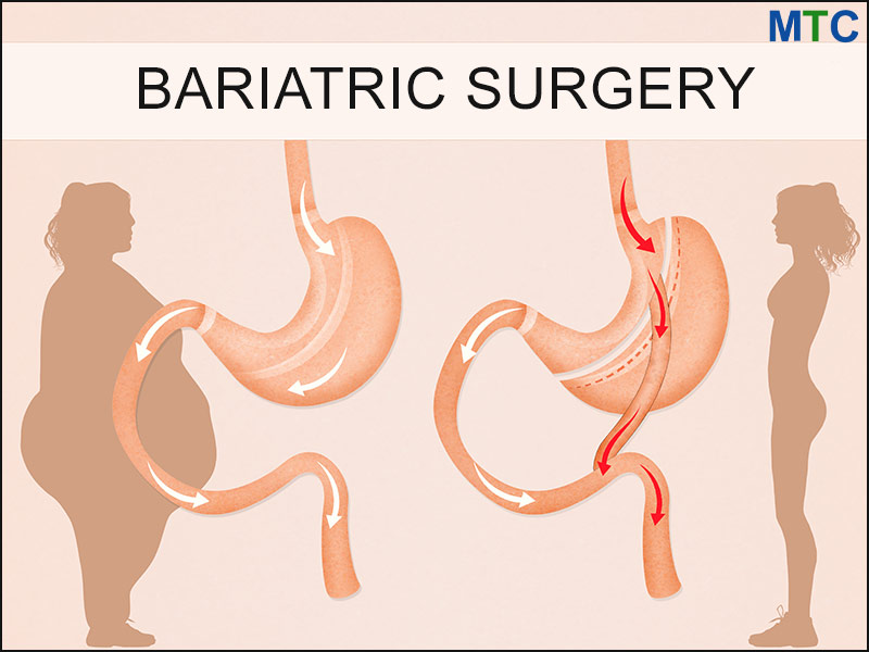 Bariatric Surgery in Cancun