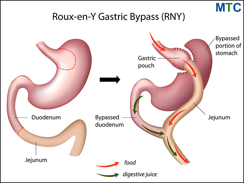 Gastric bypass in Istanbul