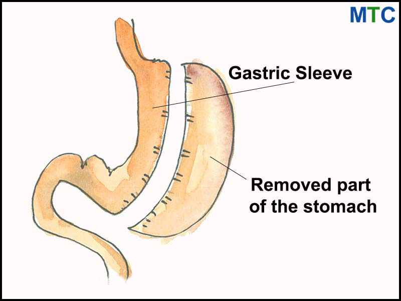 Gastric Sleeve
