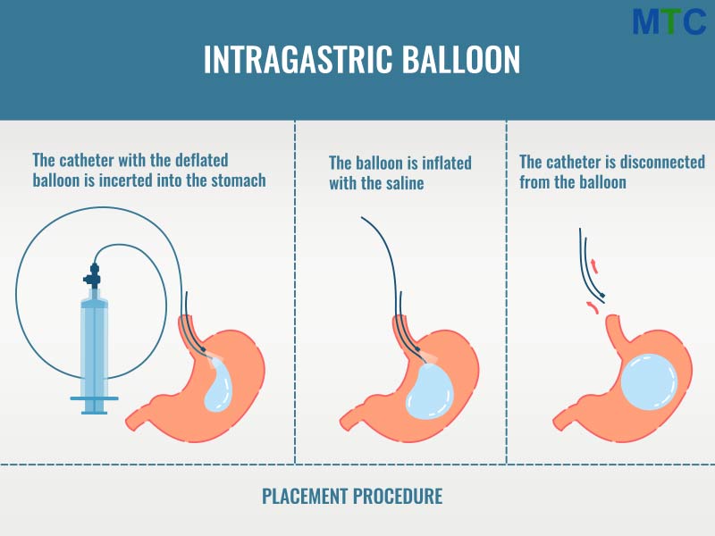 Gastric Balloon in Cancun, Mexico- Procedure