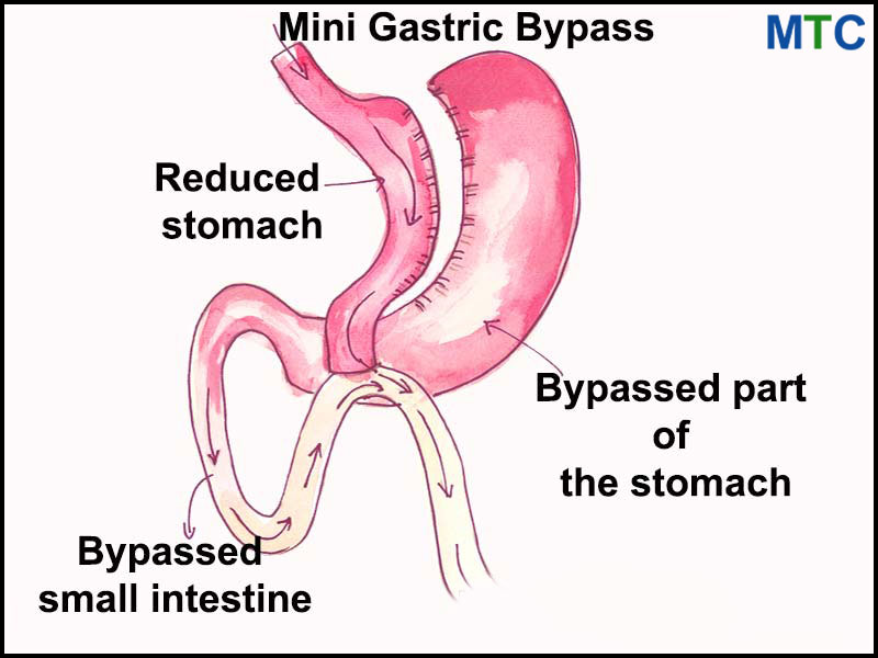 Mini Gastric Bypass Illustration