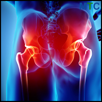 Posterior Approach to Hip Replacement