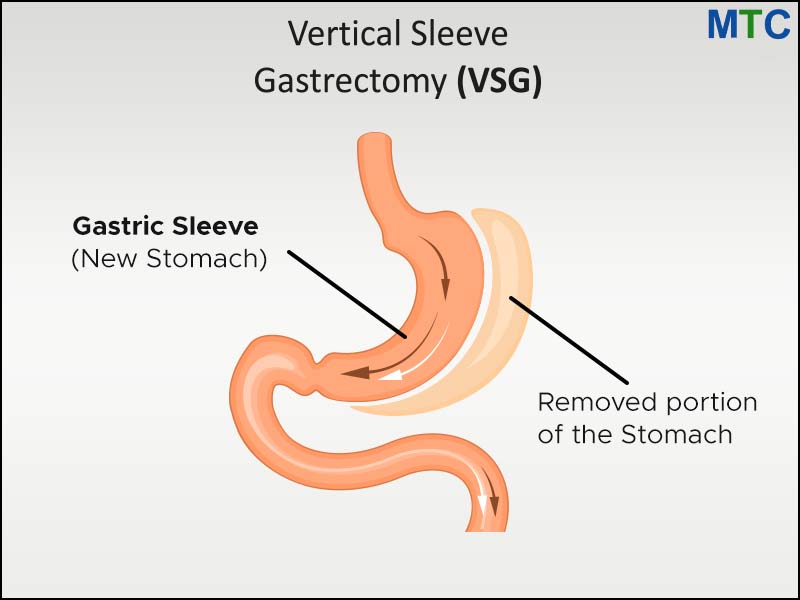 Vertical Sleeve Gastrectomy (Gastric Sleeve) in Turkey