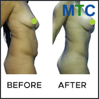 Before and after image of Abdominoplasty