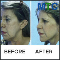 Before and after image of facelift procedure
