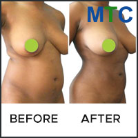 Before and after image of Liposuction