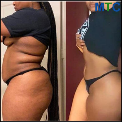 Tummy Tuck in Turkey Before and After