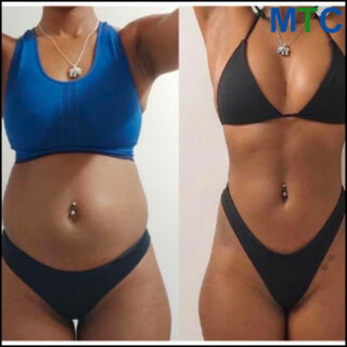 Tummy Tuck Before and After in Turkey