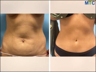 Abdominal Plastic Surgery in Lithuania Before After