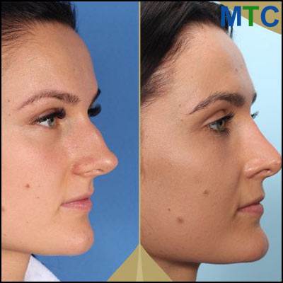 Rhinoplasty in Lithuania Before and After