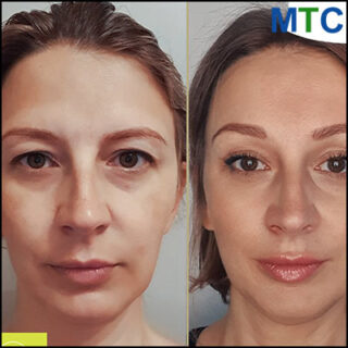 Upper Eyelid Surgery in Lithuania Before After | Medical Tourism in Lithuania
