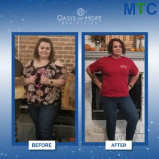 Before & After mini gastric bypass