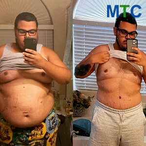 Body Transformation After Gastric Sleeve