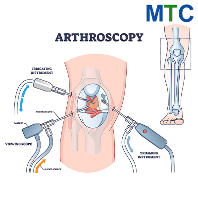 Knee Arthroscopy Illustration
