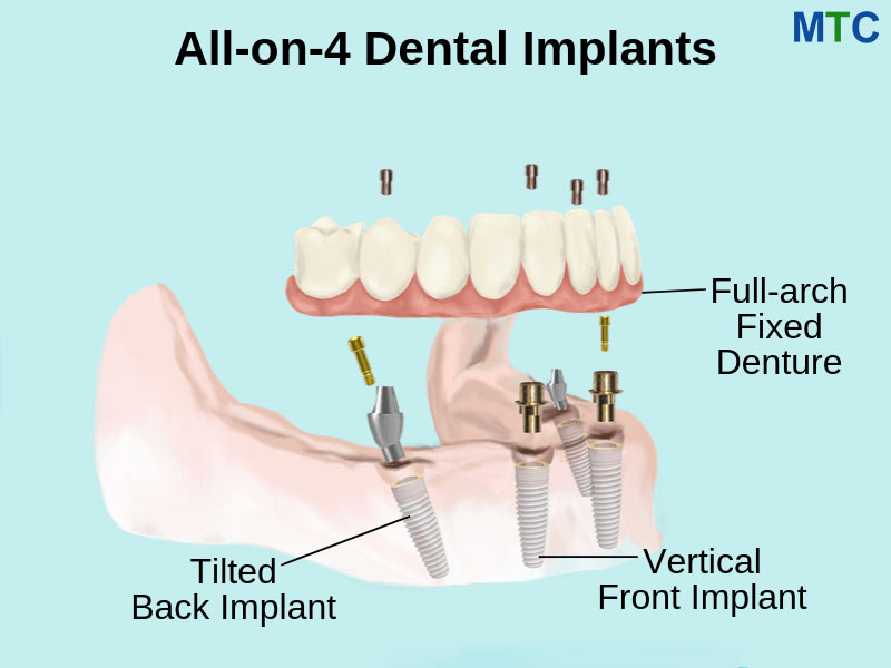 Structure of All on 4 Dental Implants