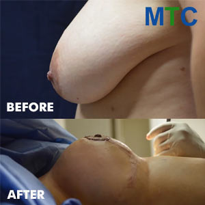 Boob lift in Tijuana - Before & After
