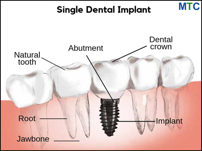 Single Dental Implant in Nuevo Progreso