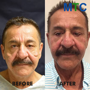 Facelift in Tijuana | Before & after photos