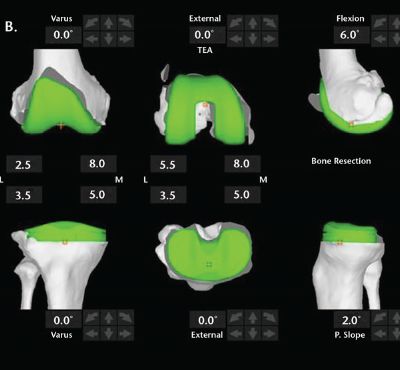 Mako imaging for robotic knee replacement
