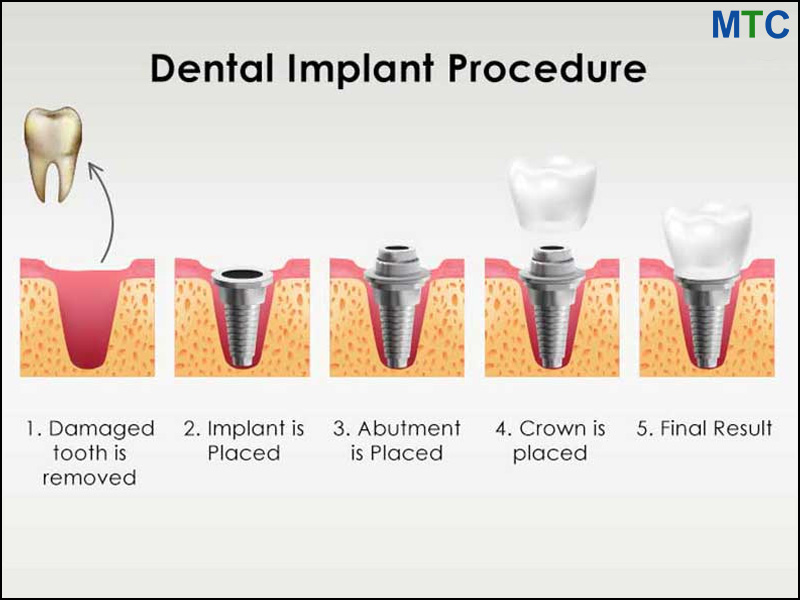 Dental Implant Procedure in Tijuana