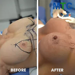 Breast lift - Before & After pics