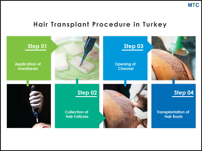 Hair Transplant Procedure in Turkey