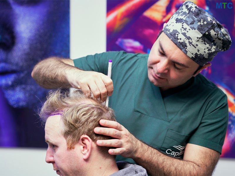 Doctor Performing Hair Transplant in Turkey