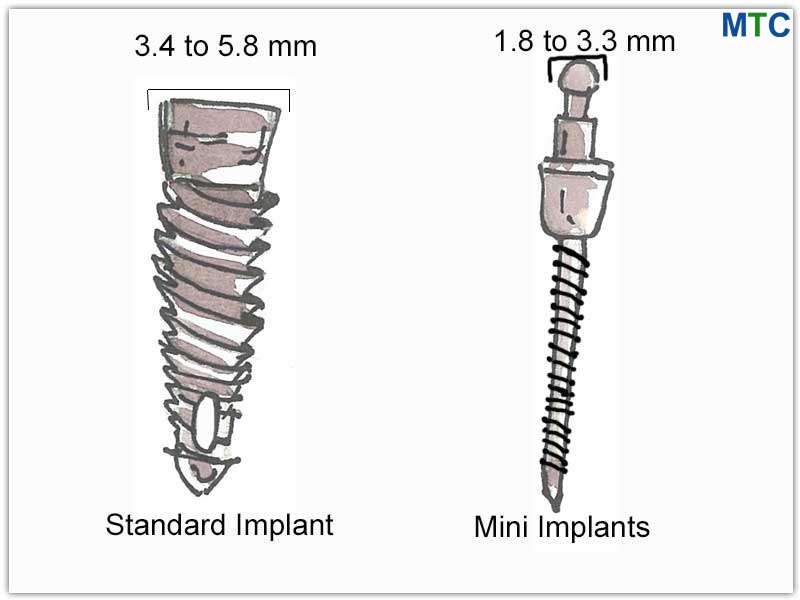 Mini vs. Regular Implant Structure