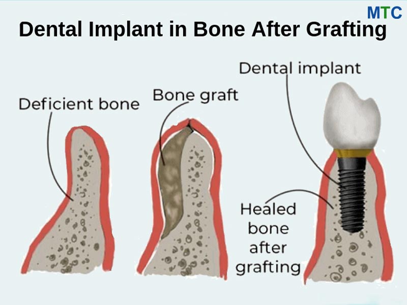 Injerto Óseo para Implantes Dentales