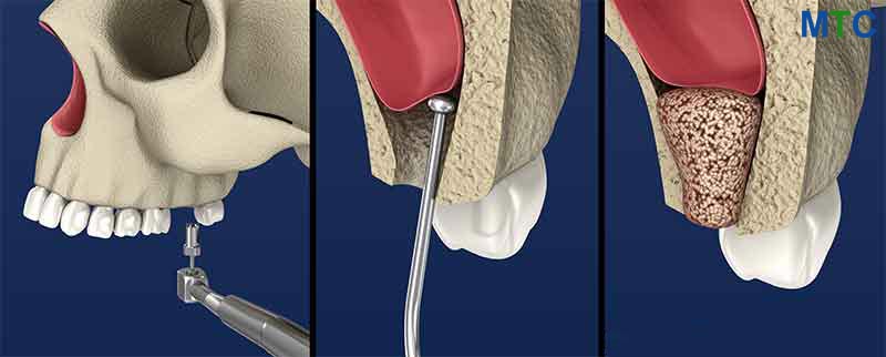 Sinus Lift & Bone Grafting Procedure