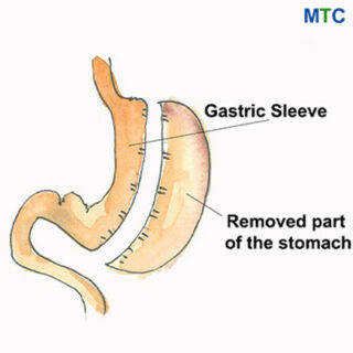 Gastric Sleeve | Type of Weight Loss Surgery in Piedras Negras