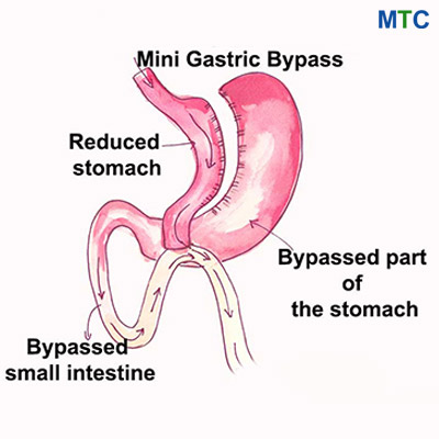 Mini-Gastric Bypass-Weight Loss Surgery in Mexico