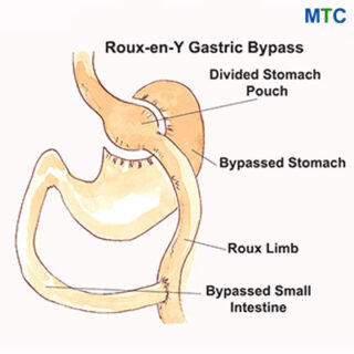 RY Gastric Bypass