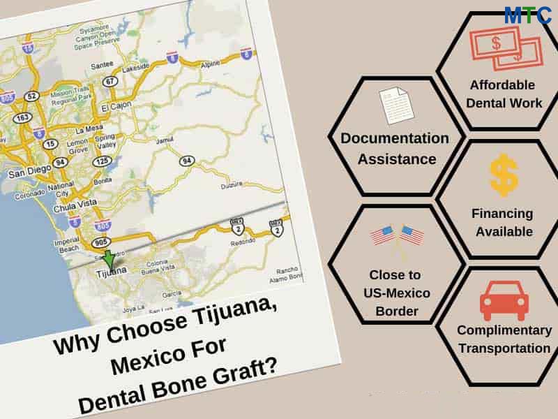 Reasons for Choosing Tijuana for Bone Graft