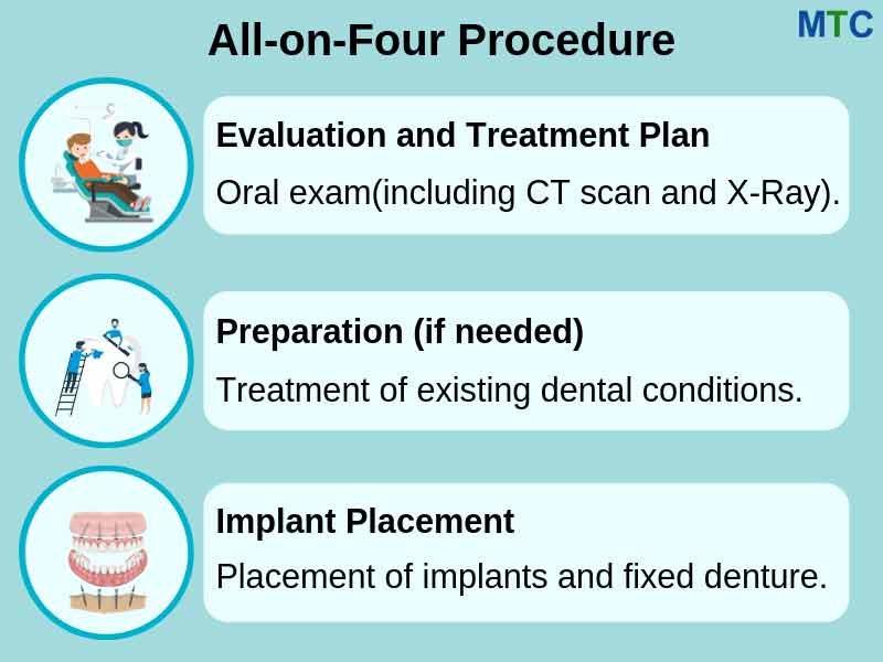 All-on-4 Implants Procedure